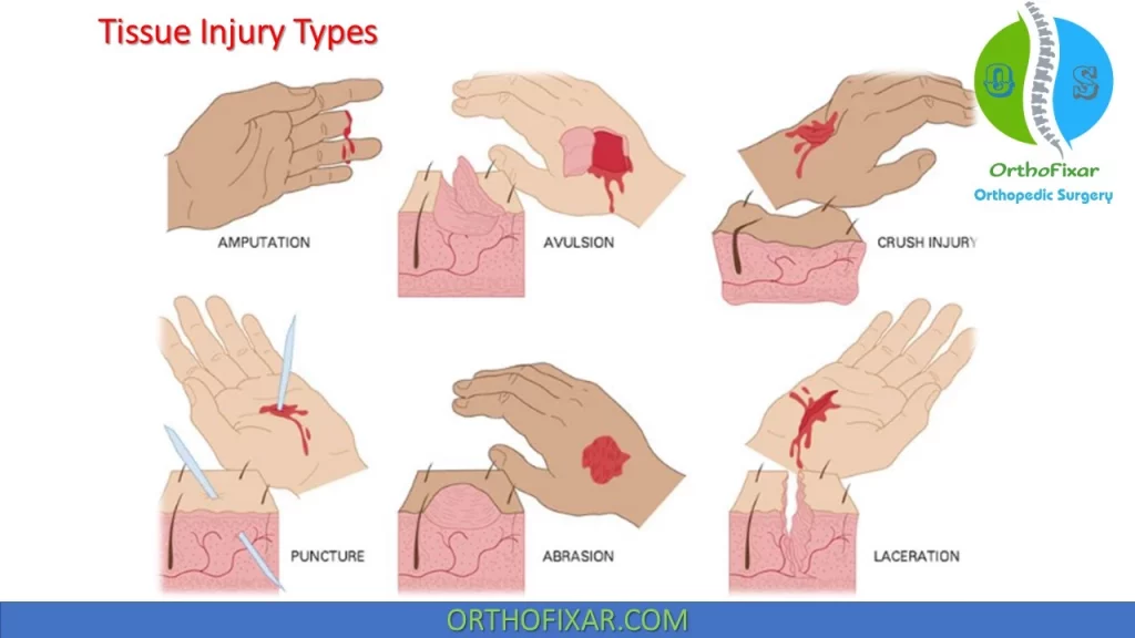 Soft Tissue Injury types