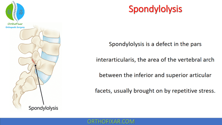 Spinal Spondylolysis