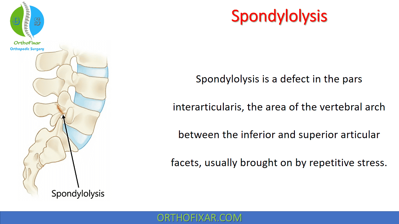  Spinal Spondylolysis 