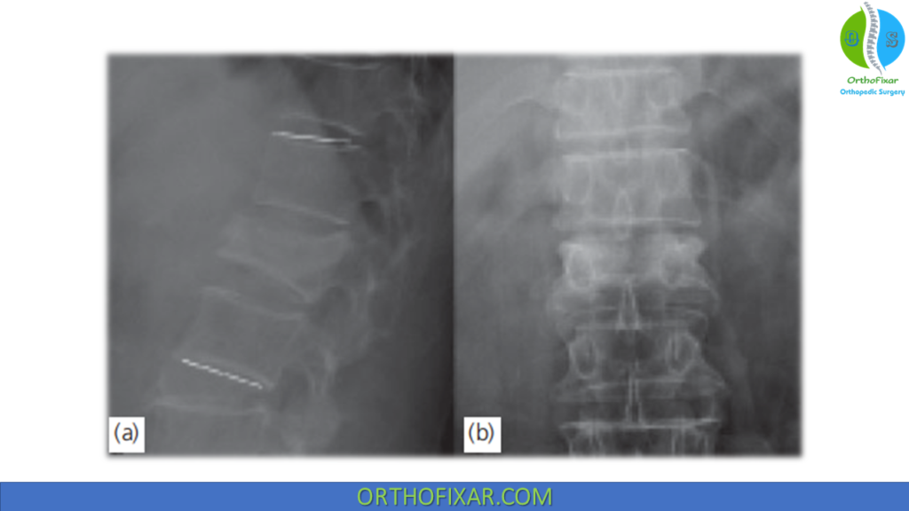 Spine Burst Fractures