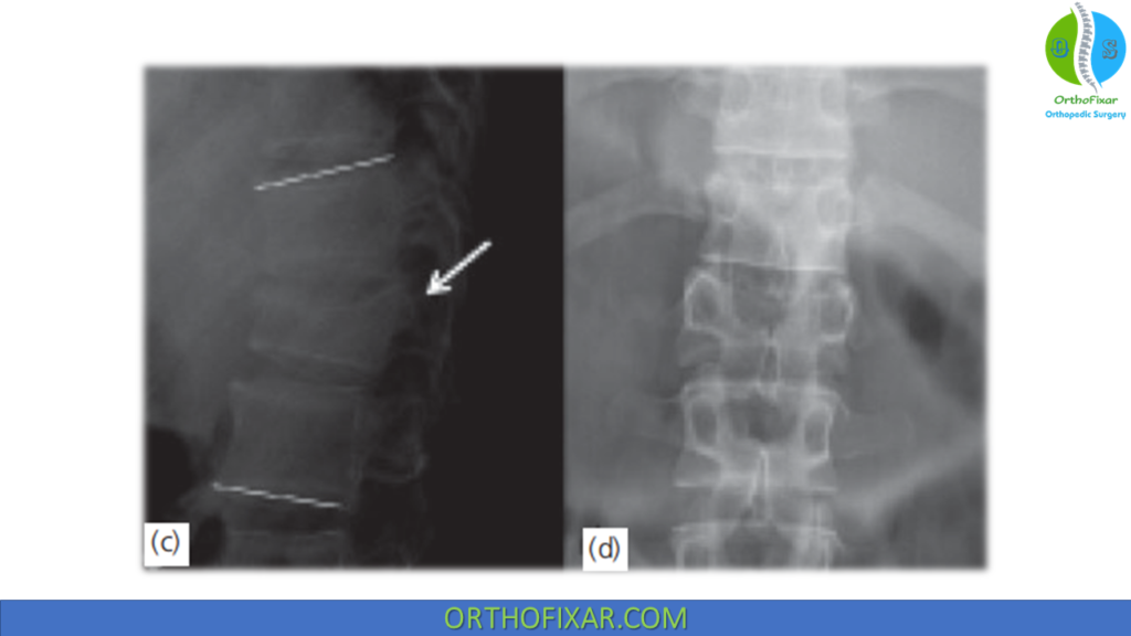 Spine Burst Fractures