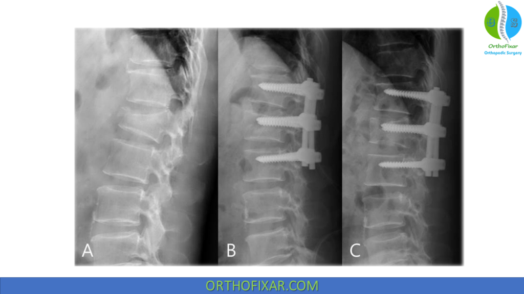 Spine Burst Fractures Treatment
