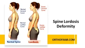 Spine Lordosis Deformity