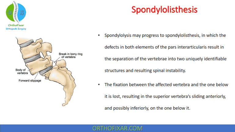 Spondylolisthesis