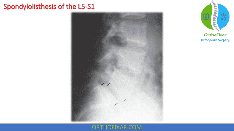 Spondylolisthesis: Causes, Symptoms & Treatment | 2024