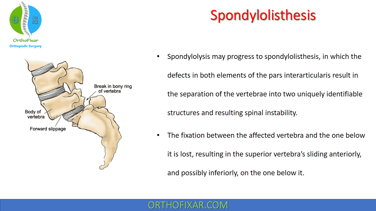 Spondylolisthesis: Causes, Symptoms & Treatment 