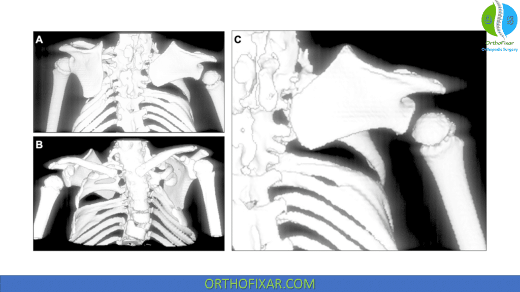 Sprengel Deformity Three-dimensional CT