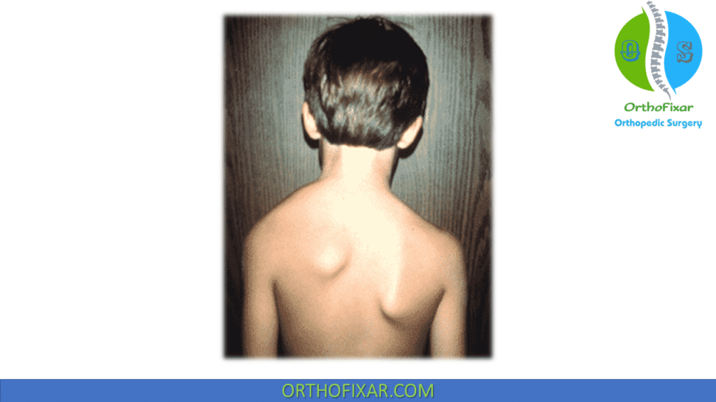 Sprengel Deformity clinical appearance