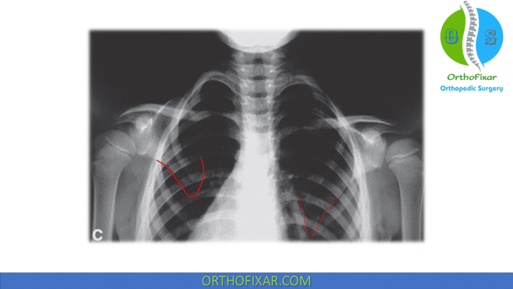 Sprengel Deformity xray