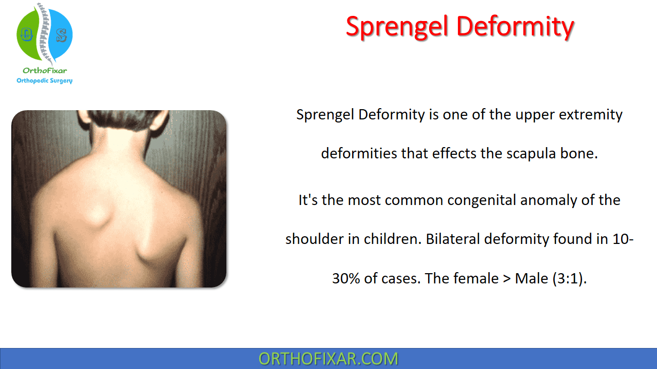 Sprengel Deformity