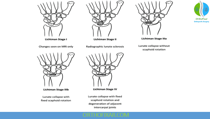 Stages of Kienböck Disease