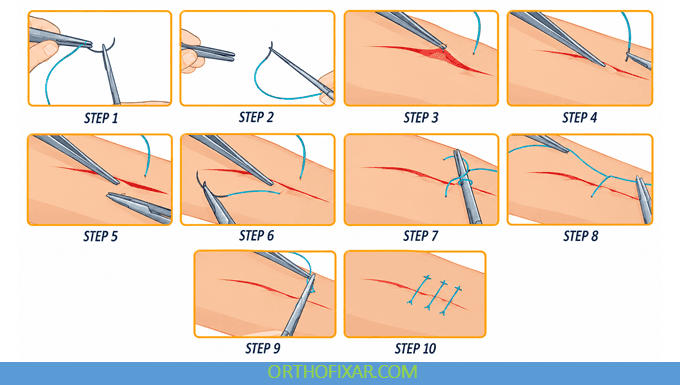 Step-by-Step Placing a Simple Interrupted Suture