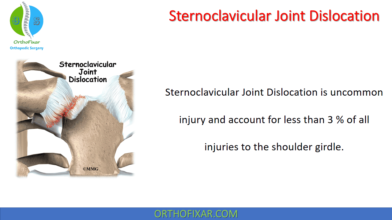  Sternoclavicular Joint Dislocation 