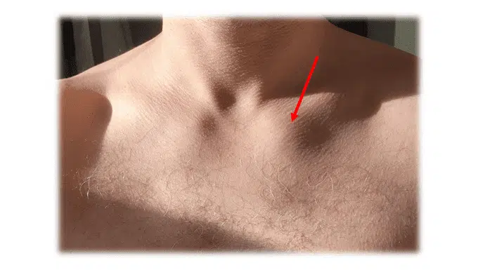 Sternoclavicular Joint Pain: Causes, Symptoms, and Treatment 2 Sternoclavicular joint swelling