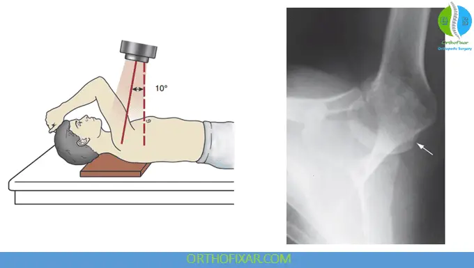 Shoulder X-ray Views 4 Stryker notch view
