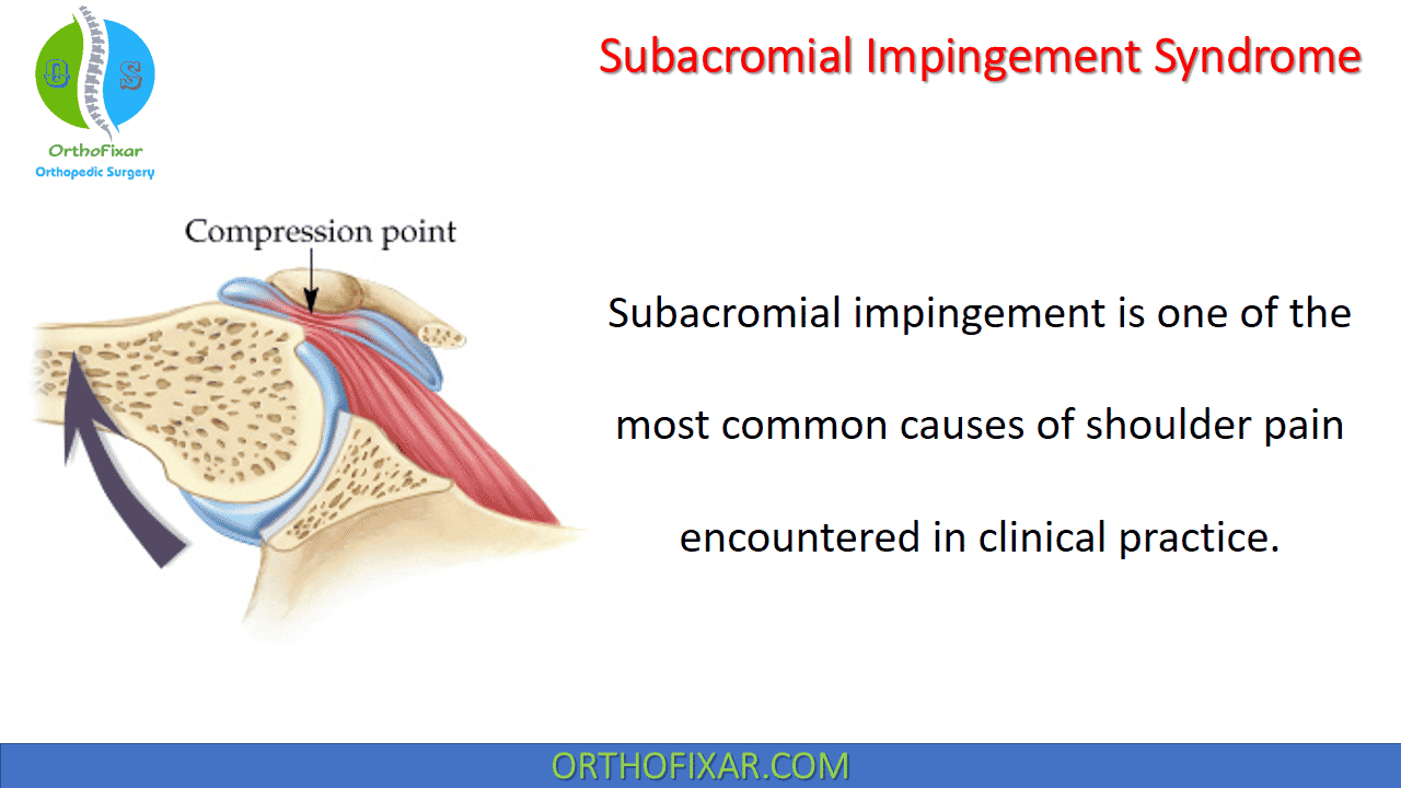 shoulder impingement diagnosis