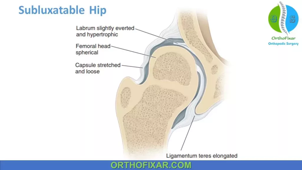 Subluxatable hip