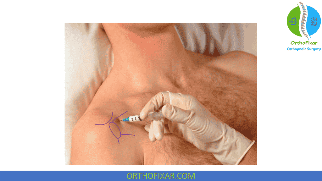 Subscapular Injection site