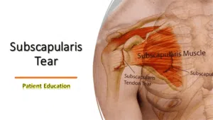 Subscapularis Tear Symptoms, Diagnosis & Treatment