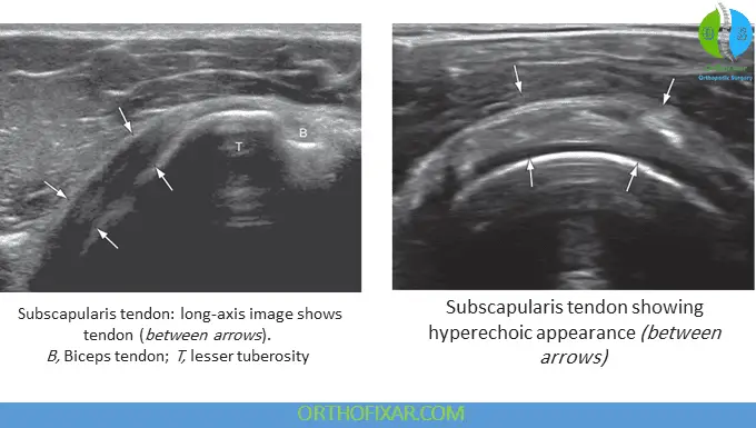 Subscapularis Tendon ultrasound view