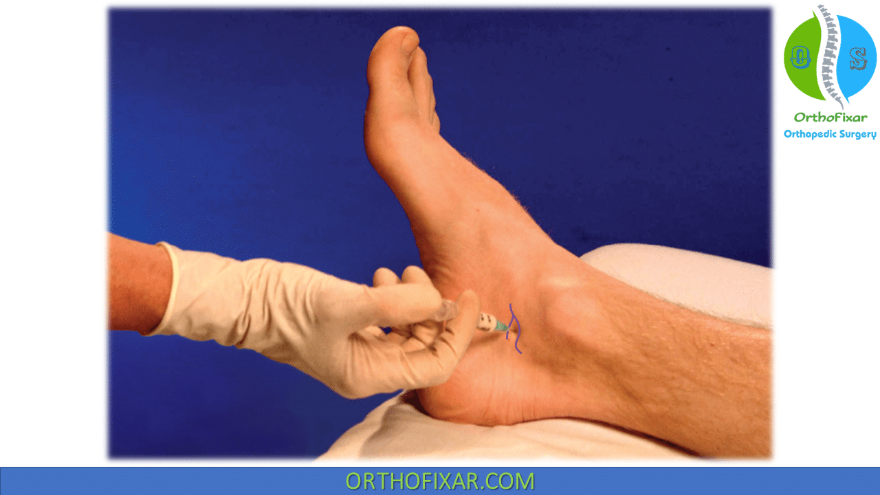 Subtalar Joint Injection