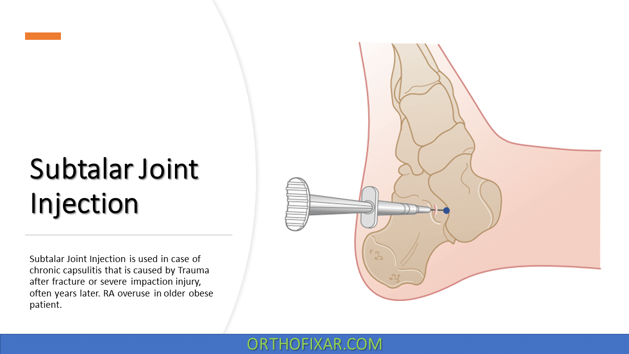  Subtalar Joint Injection 
