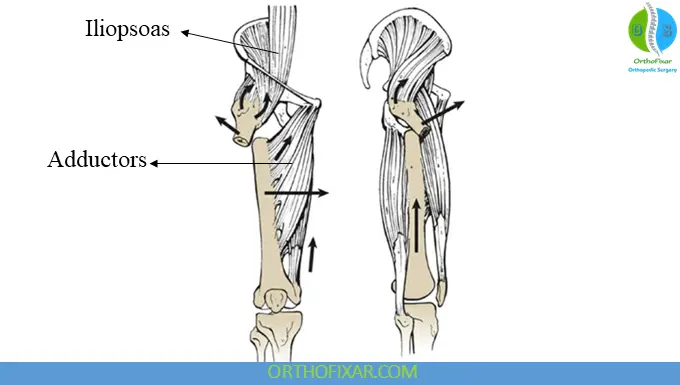 Subtrochanteric Femur Fractures Deforming Muscle Forces