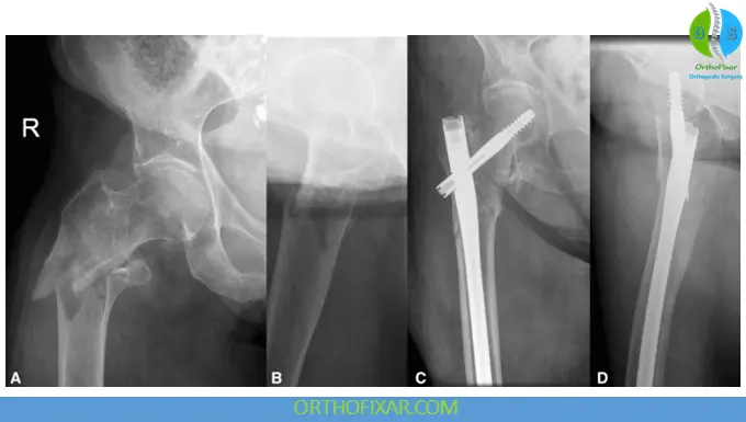 Subtrochanteric Femur Fractures treatment