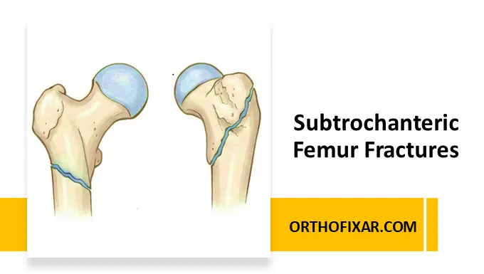 Subtrochanteric Femur Fractures