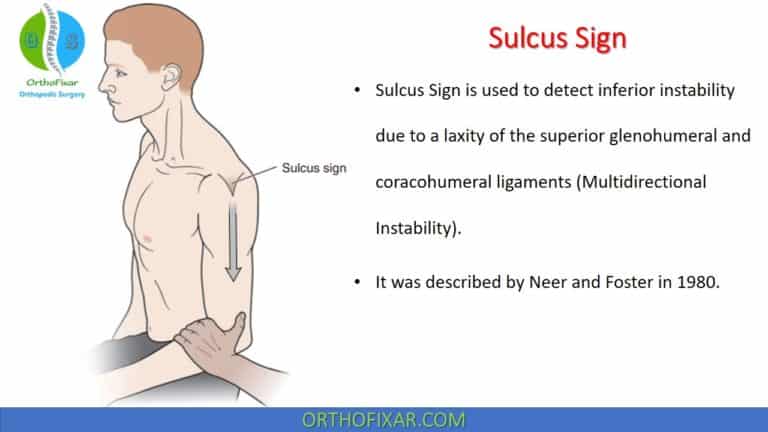 Sulcus Sign