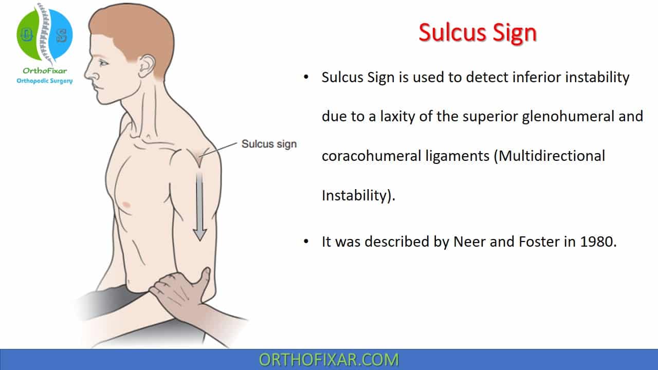  Sulcus Sign | Inferior Shoulder Instability 