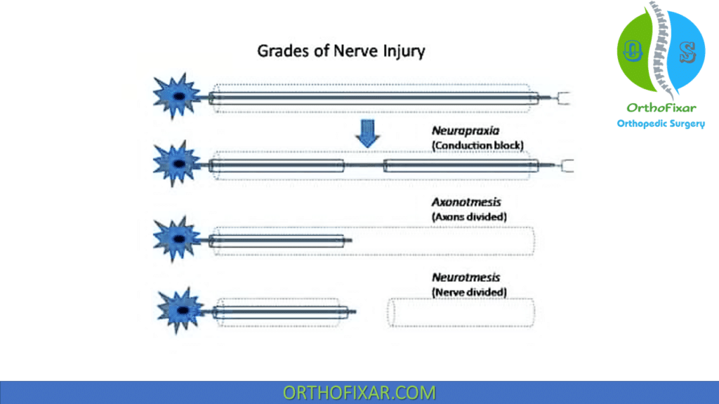 Sunderland classification of nerve injuries