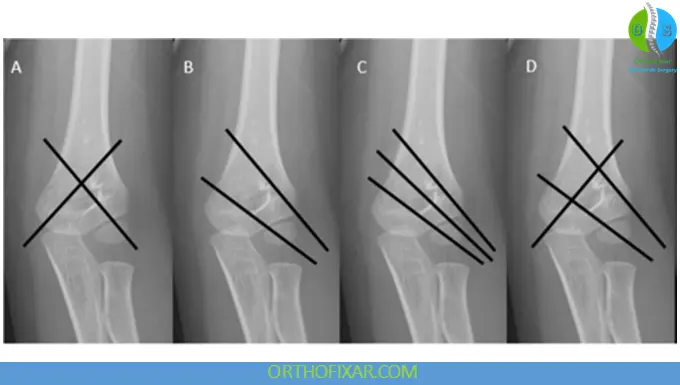 Supracondylar Humerus Fractures pins fixation options