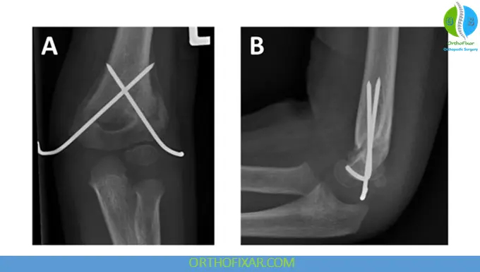 Supracondylar Humerus Fractures pins fixation