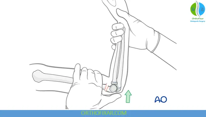 Supracondylar Humerus Fractures reduction