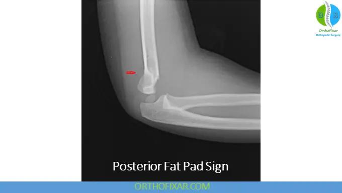 Supracondylar Humerus Fractures - Posterior fat pad