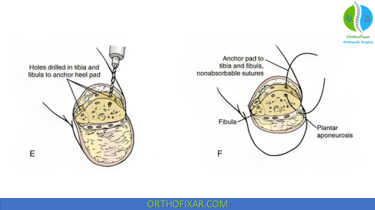 Syme Amputation & Prosthesis | OrthoFixar 2024