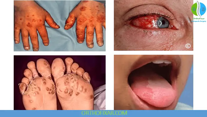 Symptoms of Reiter's Syndrome