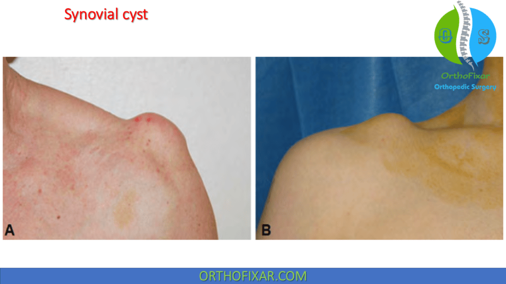 Synovial cyst involving the AC joint