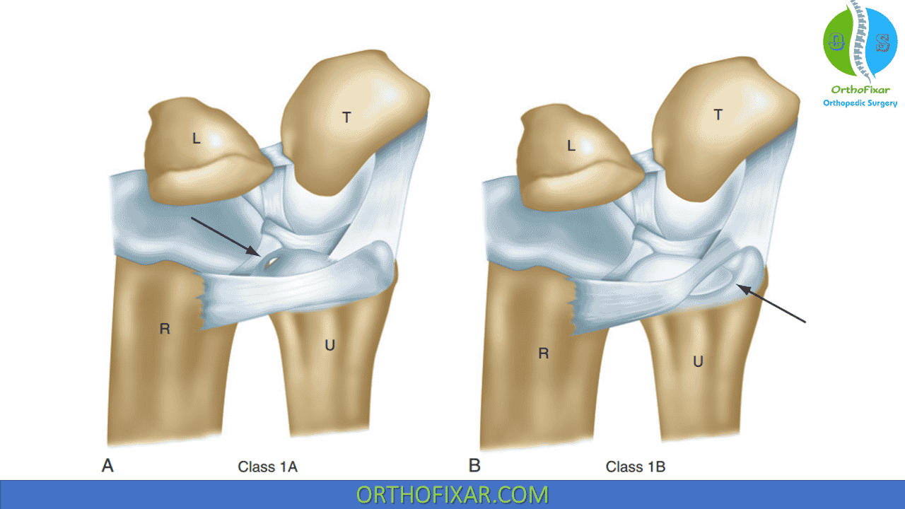 Triangular Fibrocartilage Complex