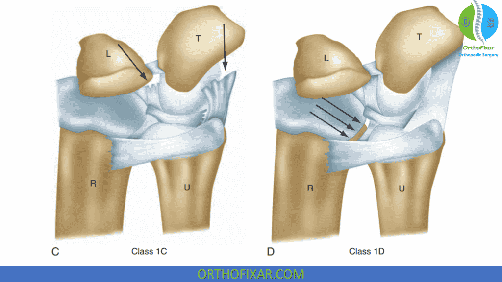TFCC injury classification (2)