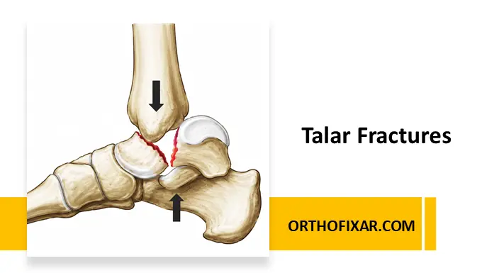 Talar Fractures