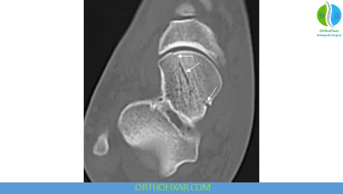 Talar Head Fracture