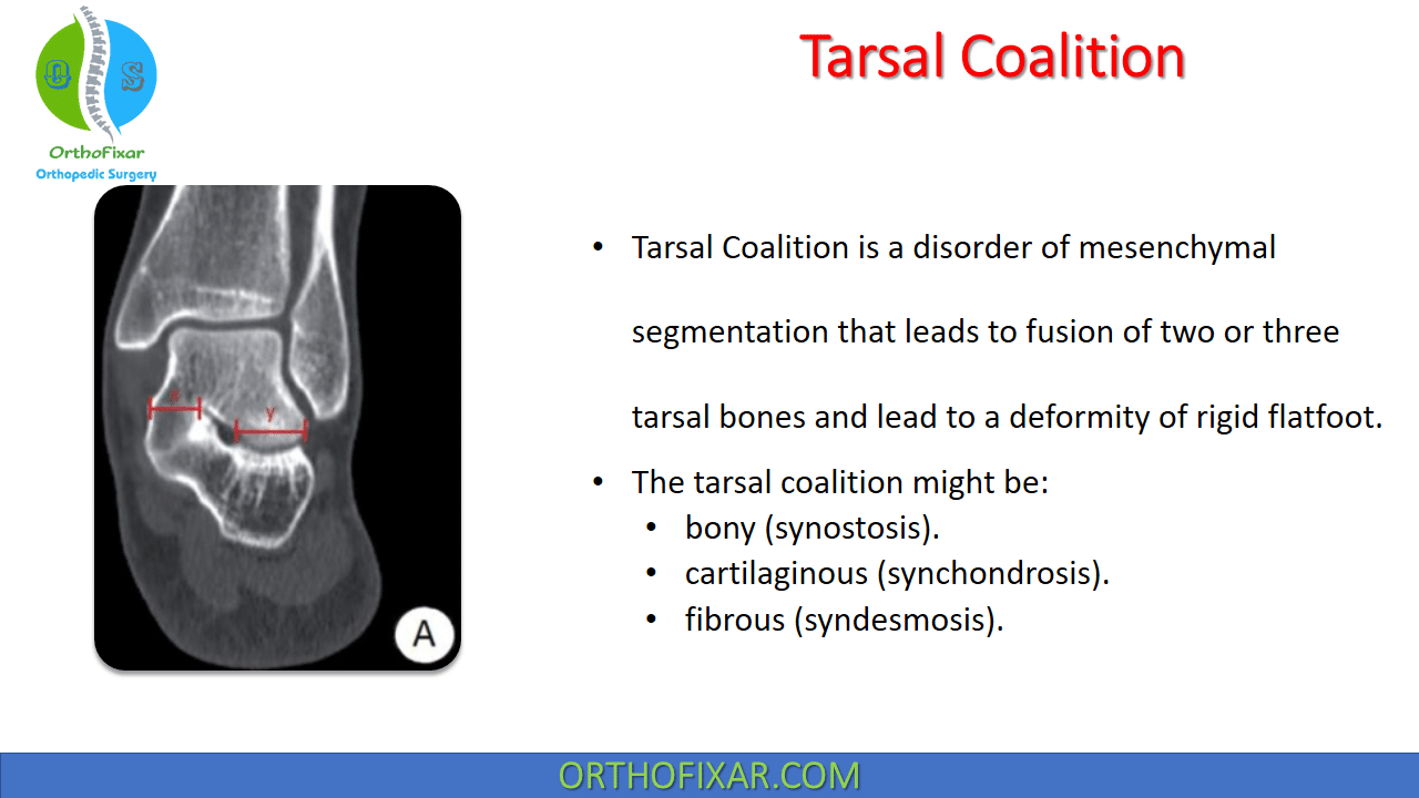 Tarsal Coalition Easy Explained Orthofixar 2024