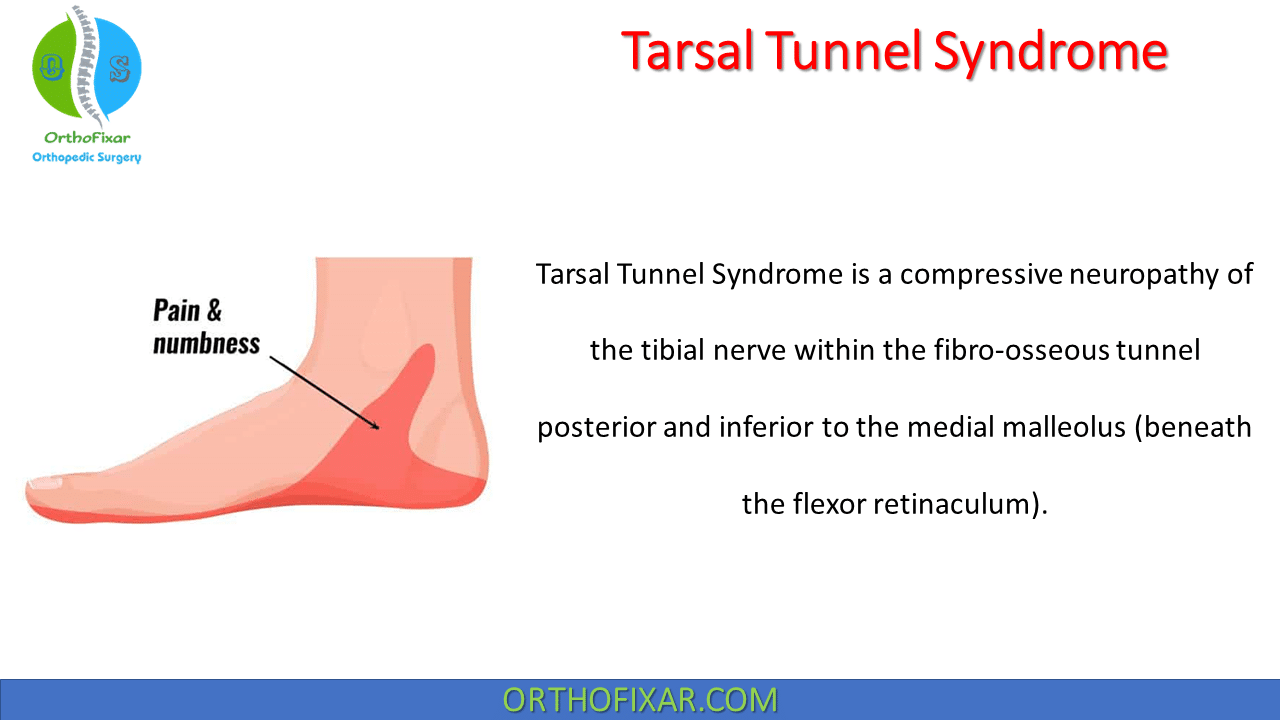 Tarsal Tunnel Syndrome - Triangle Physiotherapy