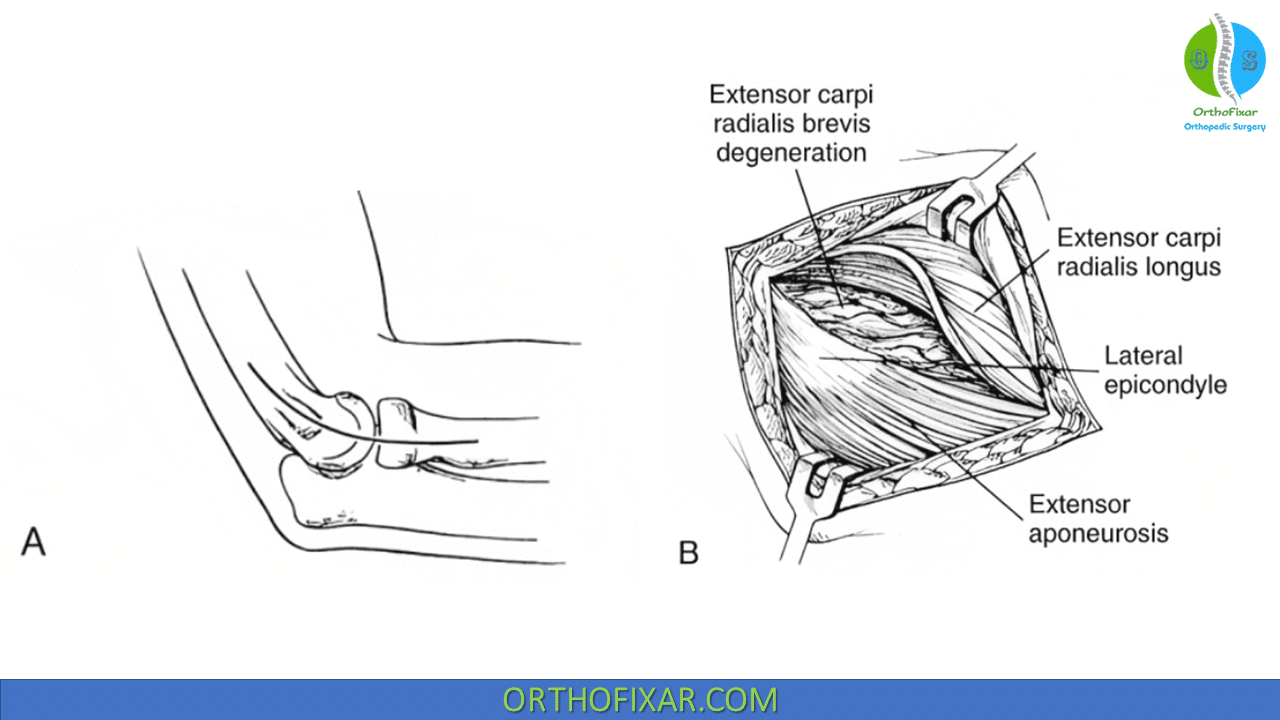 Tennis Elbow Surgery OrthoFixar 2024