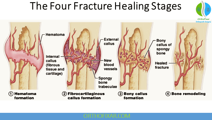 The Four Fracture Healing Stages