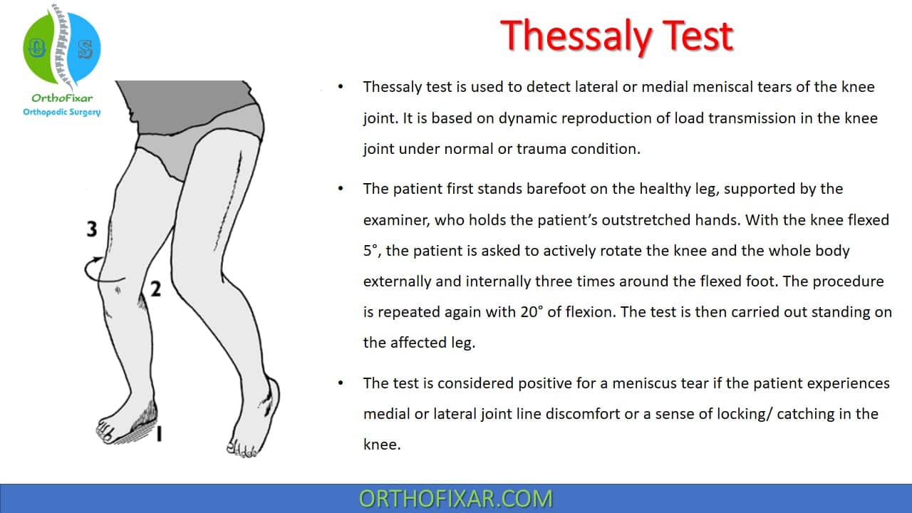  Thessaly Test for Knee Meniscal Tears 