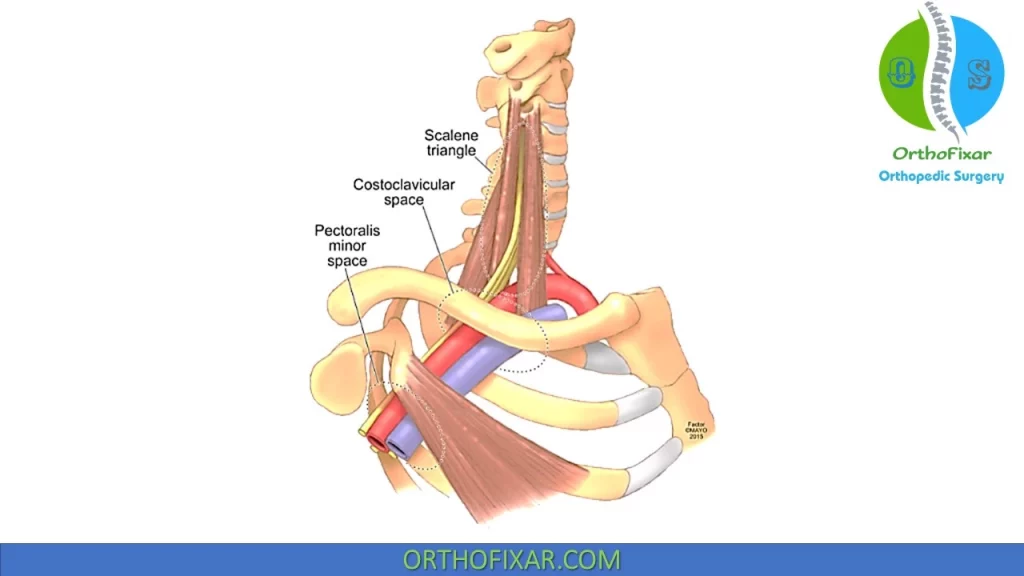 Thoracic Outlet Syndrome compression sites