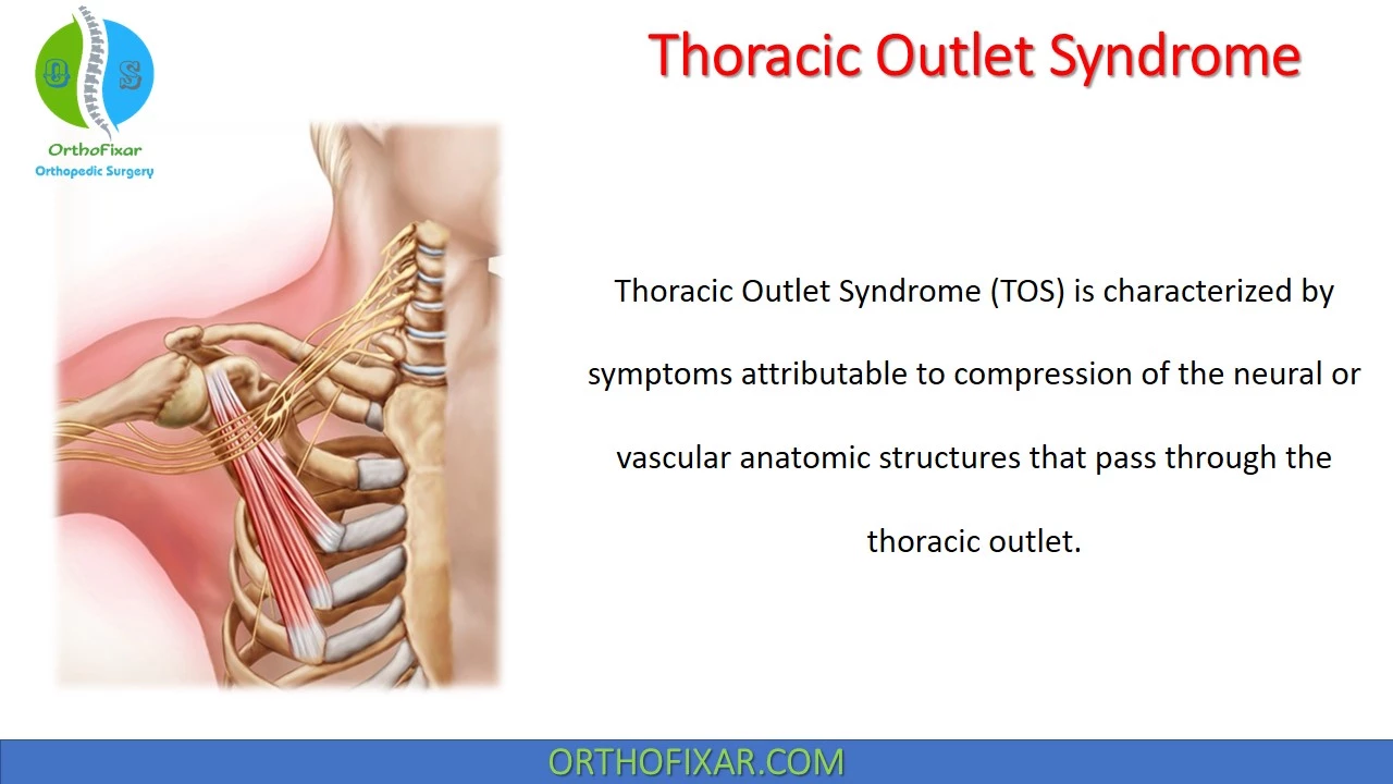  Thoracic Outlet Syndrome (TOS) 